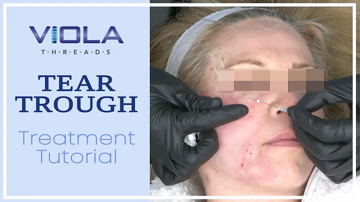 Viola Threads Undereye Tear Trough Treatment Tutor...