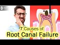What are different reasons for a Root Canal failure?| Failed root canal-Dr. Hussain Iqbal Wardhawala