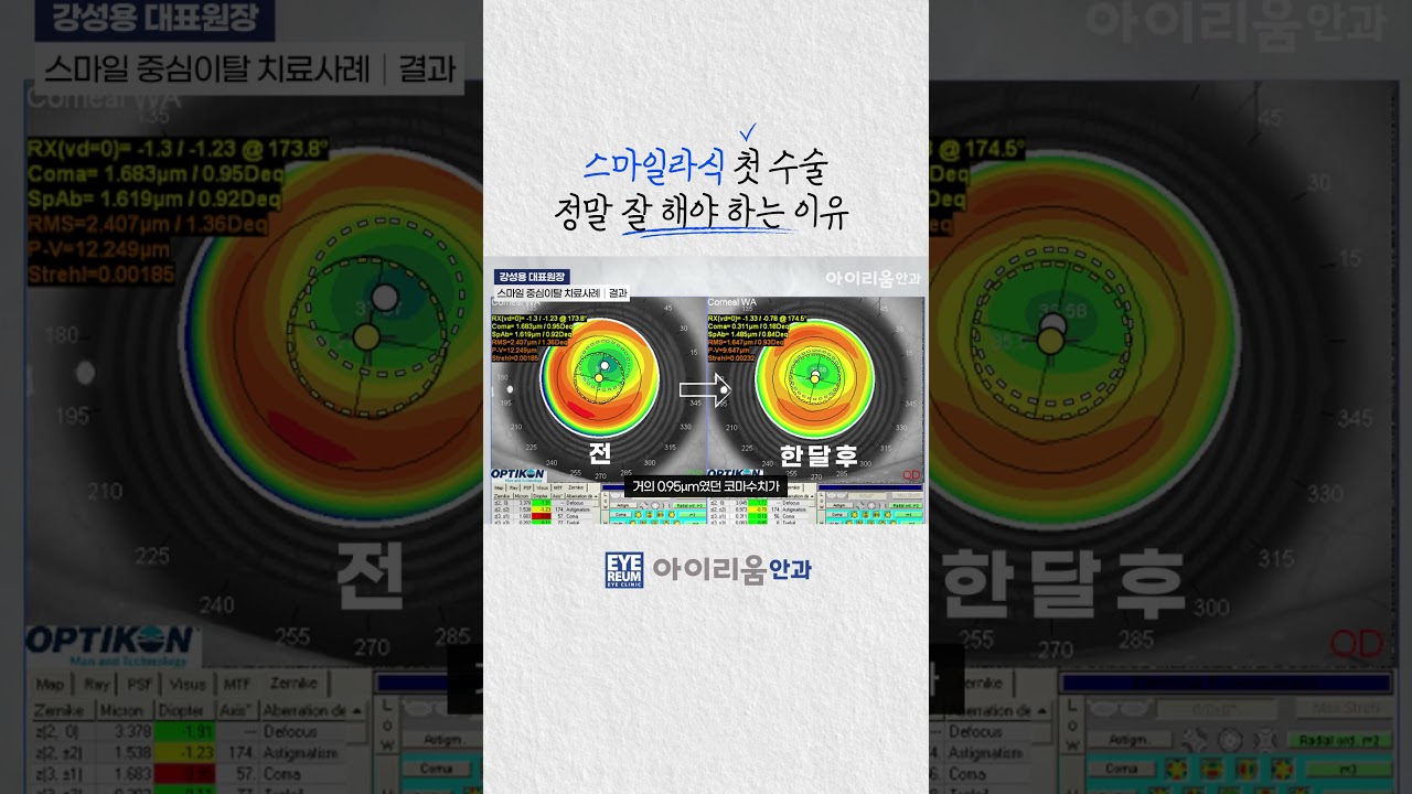 [Айриум Нүдний эмнэлэг] Смайл ласик мэс заслыг сайн хийдэг газар : Смайл ласик мэс засал, анхны удаа чухал.