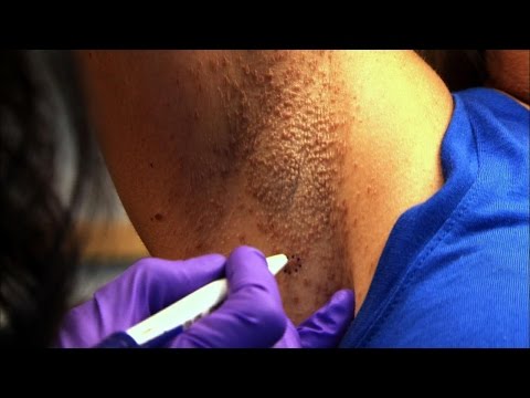 Woman&rsquo;s Armpit Mystery Skin Condition Solved
