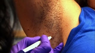 Woman's Armpit Mystery Skin Condition Solved