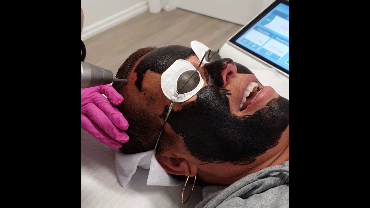 Hollywood Laser Carbon Peel Cairns Laser YouTube