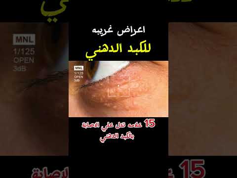 اعراض الكبد الدهني علامات تشحم الكبد