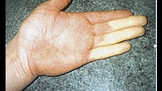 vibration white finger prevention What is 'White Finger'? | Norton Abrasives main image 1