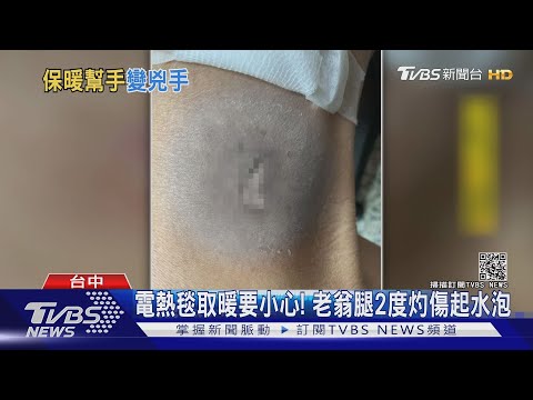 電熱毯取暖要小心! 老翁腿2度灼傷起水泡｜TVBS新聞