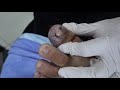 Ep_1428 Big ingrown toenail removal 👣 มันจะทะลุ 😷 (This clip is from Thailand)