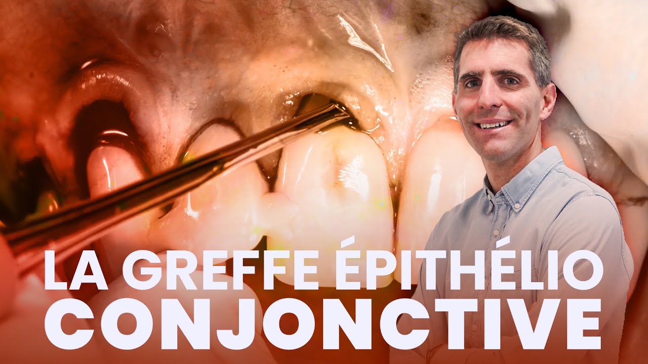 ​Maîtriser la Greffe Épithélio-Conjonctive :  Le protocole pas à pas