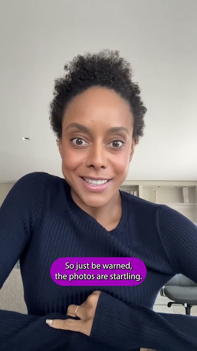 Victoria's Lupus Flare