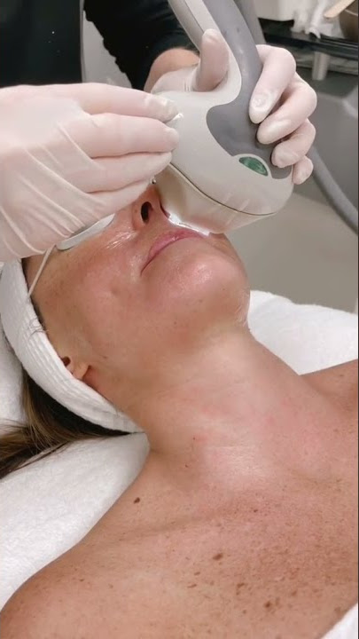 IPL Treatment