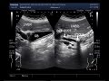 Ultrasound Video showing tracing of a stone in bile duct.