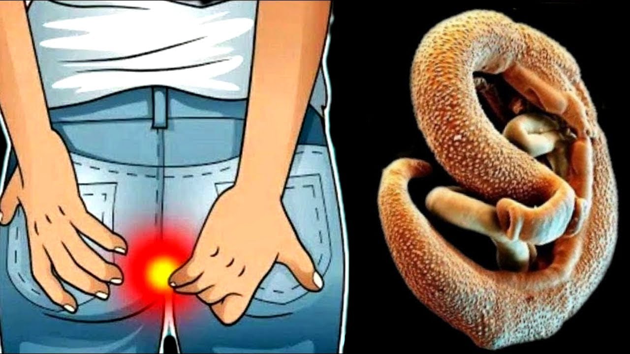 Der Körper selbst wirft tote Parasiten aus! Das beste natürliche