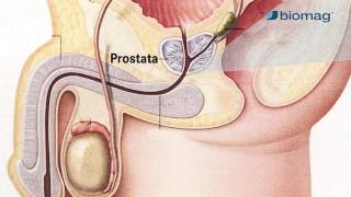 pathophysiology of acute bacterial prostatitis