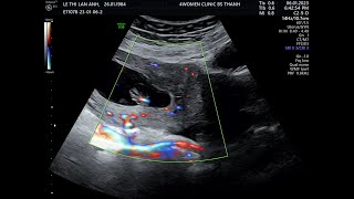 Siêu Âm 5D Bs Thành - Lê Thị Lan Anh 0601 - 4Womenclinic