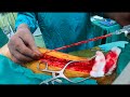 Coronary Artery Bypass: Saphenous Vein Graft Preparation and Anastomosis to PDA