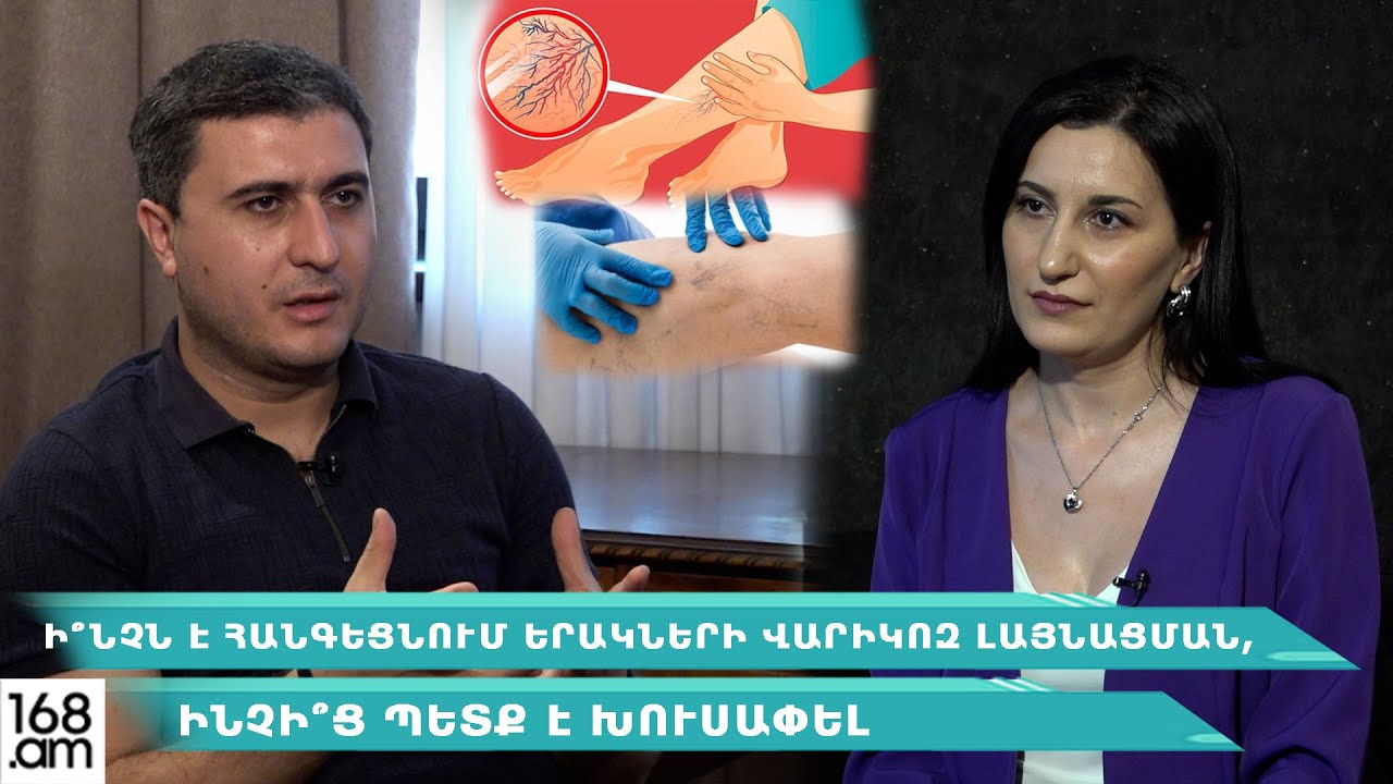Դա այն գինն է, որի համար վճարում ենք. Ի՞նչն է հանգեցնում  վարիկոզի, ինչի՞ց պետք է խուսափել