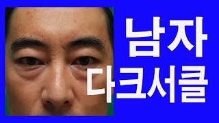 남자 다크서클