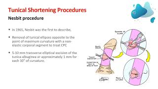 Surgical Treatment of Penile Curvature