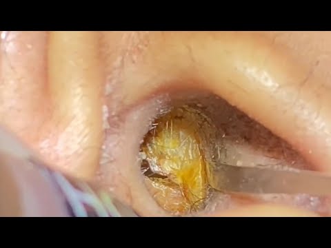 ASMR Ear Cleaning – What We Pulled Out Shocked Even the Patient