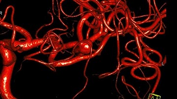 Woven EndoBridge WEB device deployment through a stent. Intracranial aneurysm treatment with WEB.