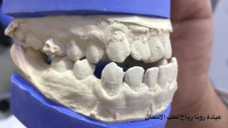 علاج تقويم الاسنان في عيادة رونا رباح لطب الاسنان دبي braces treatment dental in Dubai 045586998