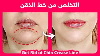How to naturally get rid of the chin crease line (mental crease) |  التخلص بشكل طبيعي من خط الذقن