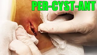 Double Bubble Cyst!  Dr. Gilmore Cyst Removal