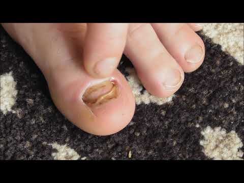 Videó: Hogyan lehet kijavítani a leesett gumit nyálkával?