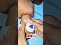 Injection Se Bhi Aasan – Cannula Insertion 😲 #medical #pharmcist #pharmecy #ashishmedicoboy #shorts