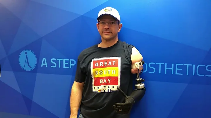 Upper Extremity Amputee with Osseointegration | Limb Replacement with Titanium implant