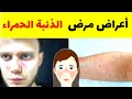 كل ما تريد معرفته عن مرض الذئبة الحمراء الاعراض الاسباب الوقاية و طرق العلاج 