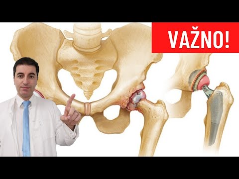 Video: Mogu li se kosti kuka smanjiti?