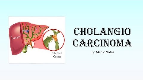 Cholangiocarcinoma - bile duct cancer, Bismuth classification, symptoms, investigation, treatment