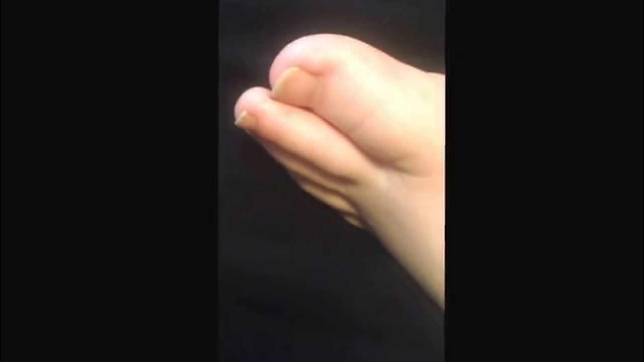 Moving my toes on my own C5 C6 Quadriplegic YouTube