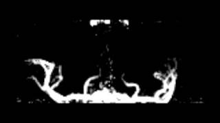 Dynamic MRA without contrast agent