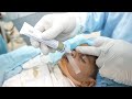 Baby Extubation Procedure After Surgery
