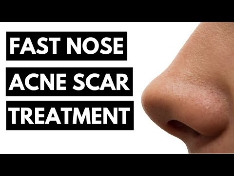 Fast Nose Acne Scar Treatment (% WORKS!) - Get Rid of Acne Scar Bumps on Your Nose