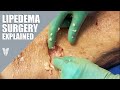 The importance of manual lipedema extraction  total lipedema care