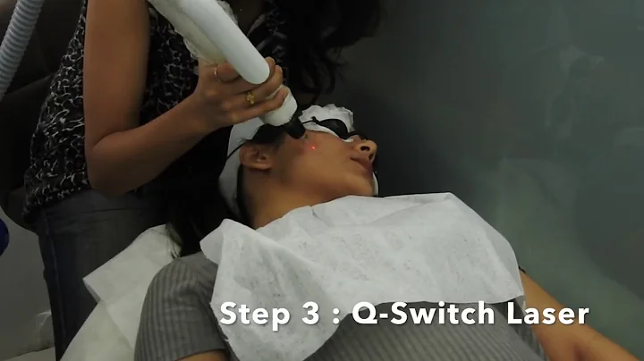Q Switch Laser Treatment at About Face India | Review