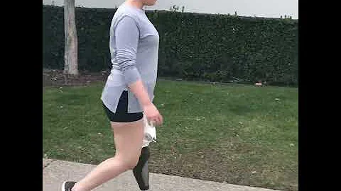 AK Amputee Jamie Walking Perfectly on New Test Socket
