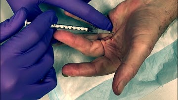 Xiaflex For Dupuytren Contracture