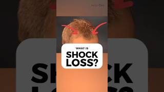 What Is Shock Loss After a Hair Transplant? 😟