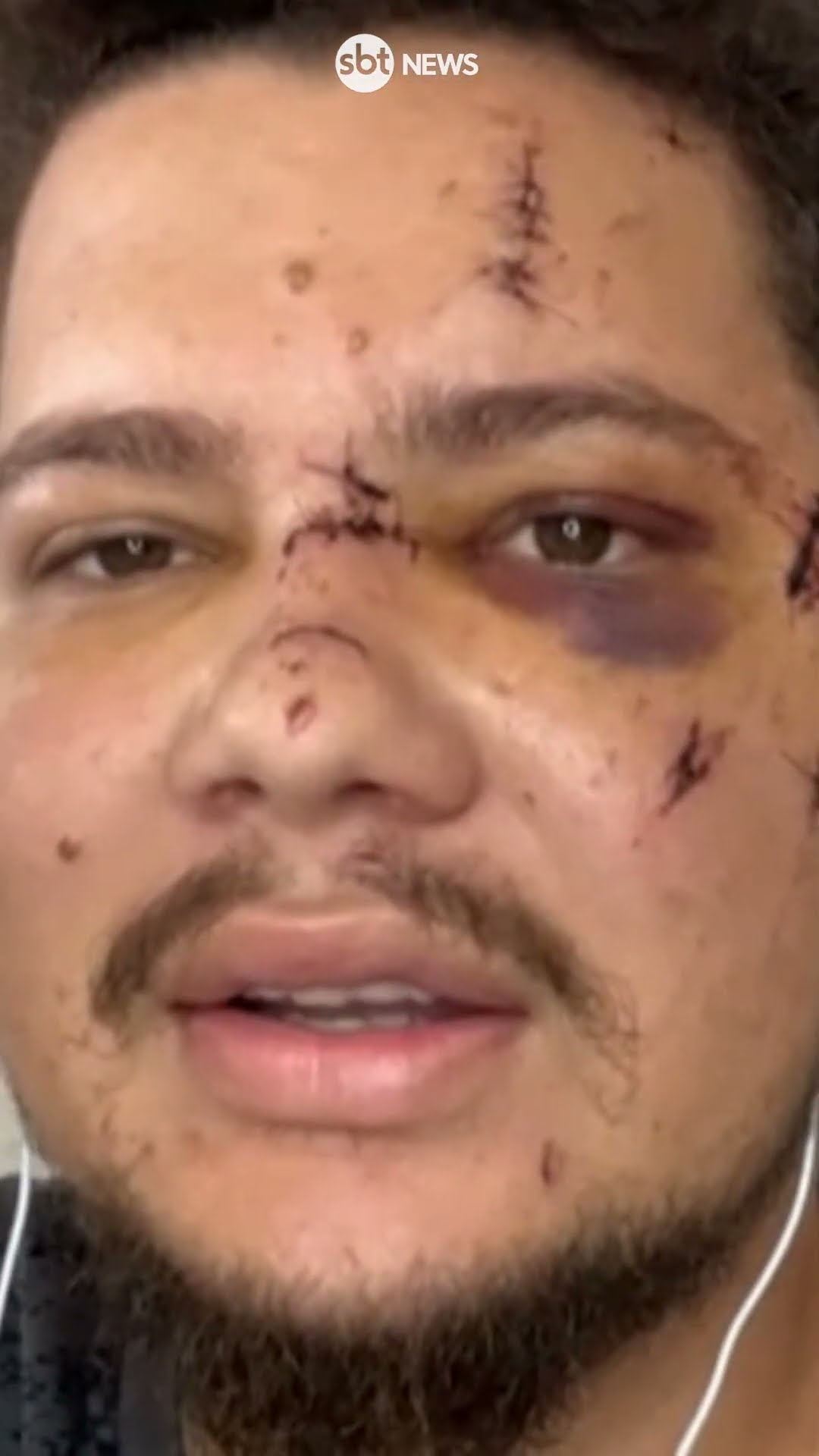 Cantor fica com rosto desfigurado após garrafada em show