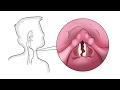 The 4 Underlying Causes of a Hoarse Voice