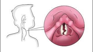 Download lagu The 4 Underlying Causes of a Hoarse Voice