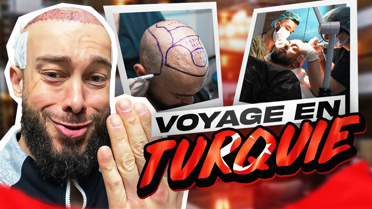 MARRE DE MA CALVITIE, JE VAIS EN TURQUIE POUR FAIRE UNE GREFFE DE CHEVEUX !