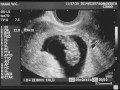 妊娠10週　胎児の心音　エンジェルサウンドでお腹の中の赤ちゃんの音を聞いてみた　10w Heart sound of fetus Angel sound