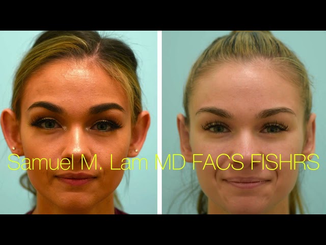 Dallas Otoplasty Testimonial and Before-and After Results