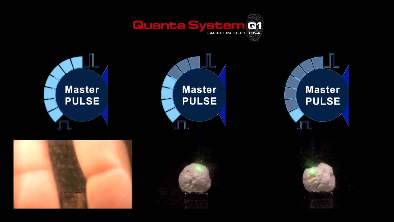 MasterPULSE technology Holmium Laser