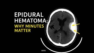 Epidural Hematoma : A Life-or-Death Race Against Time | Dr Gary Kraus, Neurosurgeon Houston TX