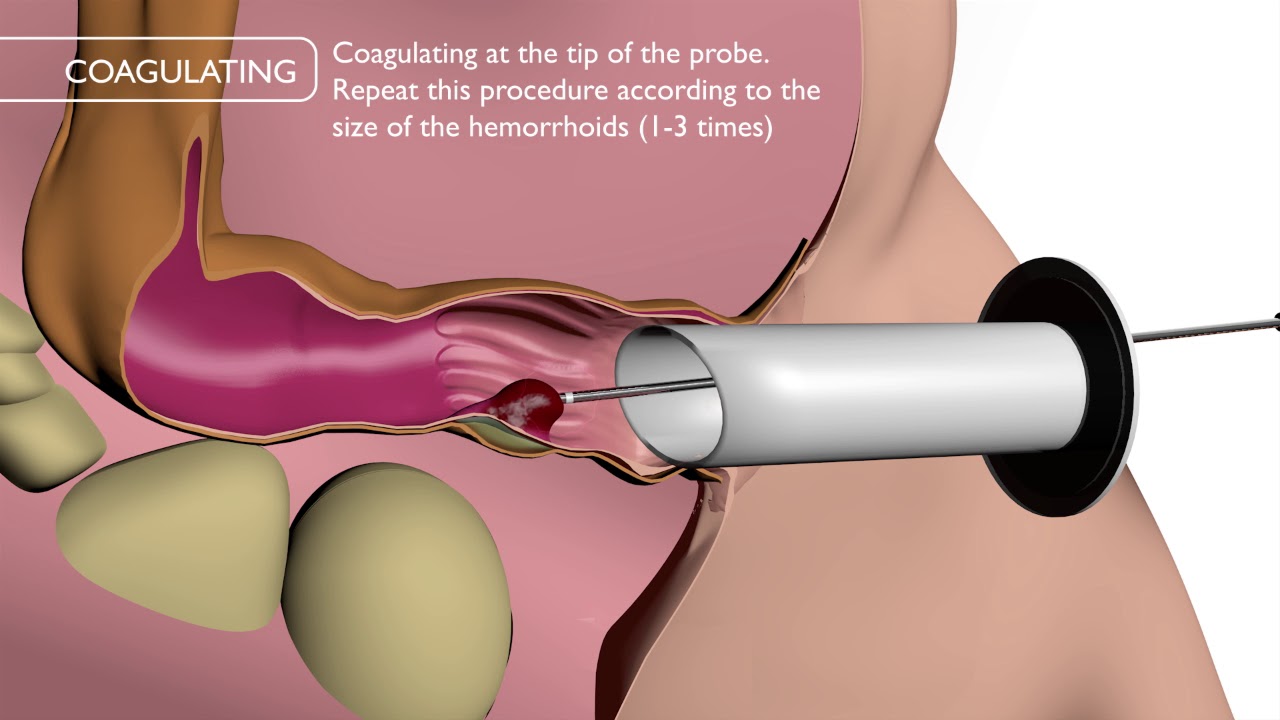 Gay hemorrhoids